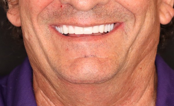 Patient after full-arch dental implant treatment by Dr. Ozayr Mahomed, Plano TX — case 1