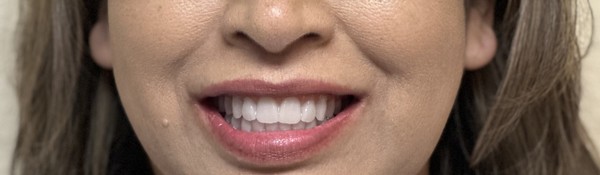 Patient after full-arch dental implant treatment by Dr. Ozayr Mahomed, Plano TX — case 2