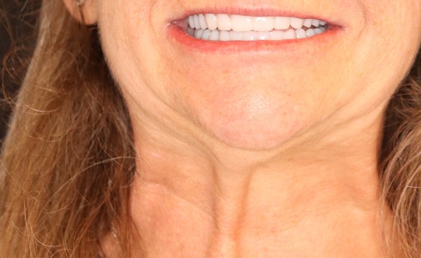 Patient after full-arch dental implant treatment by Dr. Ozayr Mahomed, Plano TX — case 3