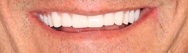 Result: patient smile after full-arch dental implant treatment by Dr. Ozayr Mahomed, Plano TX — case 1