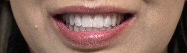 Result: patient smile after full-arch dental implant treatment by Dr. Ozayr Mahomed, Plano TX — case 2