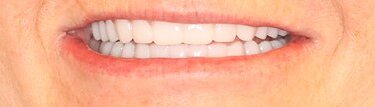 Result: patient smile after full-arch dental implant treatment by Dr. Ozayr Mahomed, Plano TX — case 3