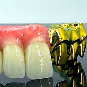 Malo Bridge — individual crowns on a gold-anodized titanium bar, Innate Dental Solutions, Plano TX