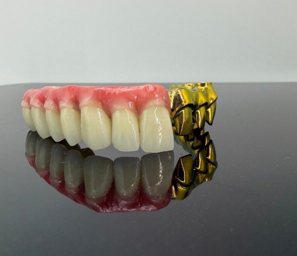 Malo Bridge — individual crowns seated on a milled titanium thimble bar, Innate Dental Solutions, Plano TX
