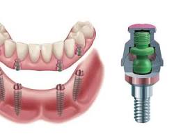 Snap-on implant-retained dentures — Plano TX